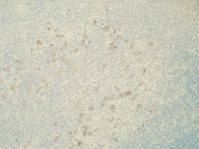 Figura 20. Inmunohistoqumica CTK AE1/AE3 con positividad en clulas neoplsicas dispersas entre abundante reaccin estromal linfoide, histioctica y de clulas gigantes. Visin panormica. 40x.